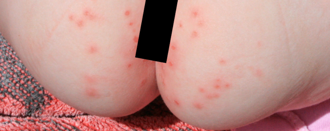 5-Essential-Facts-About-Diaper-Rash